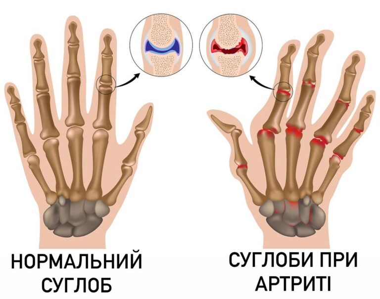 Що таке ревматоїдний артрит і як його розпізнати вчасно