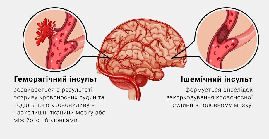 Що таке інсульт: механізм, види і перші ознаки