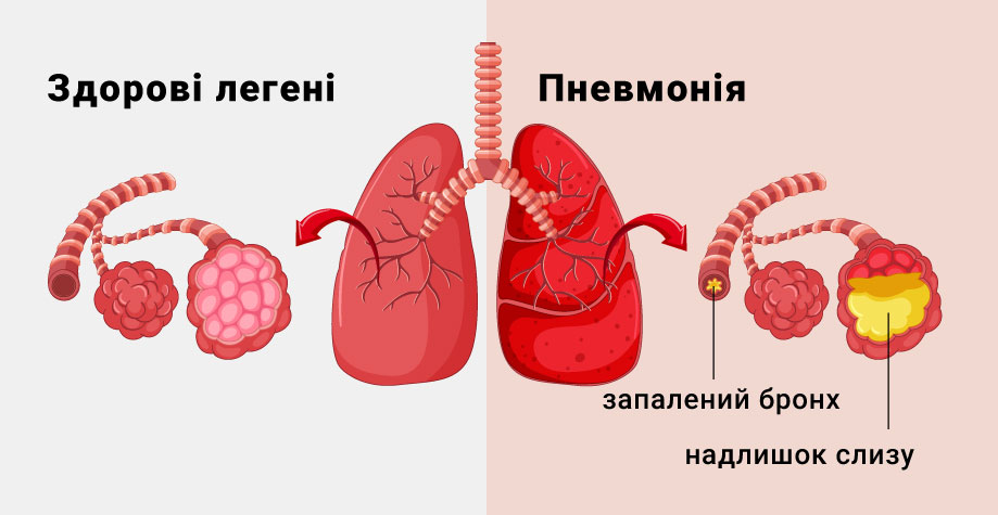 Чи передається пневмонія від людини до людини